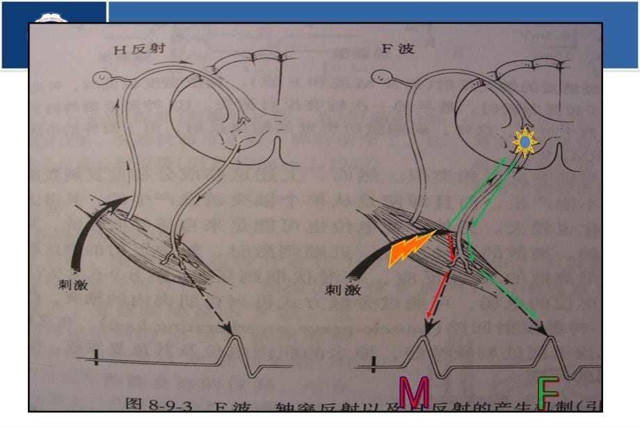 肌电图课件-h反射与f波的区别_第5页