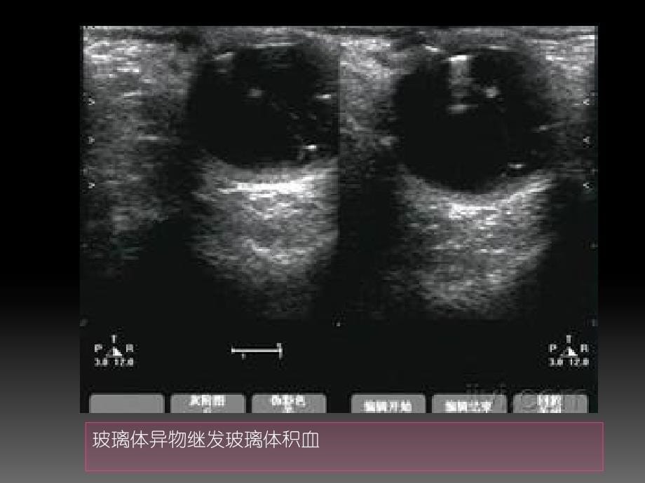 玻璃体积血患者的护理_第5页