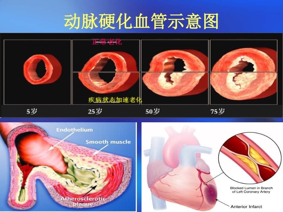 冠心病-竞赛课件_第5页