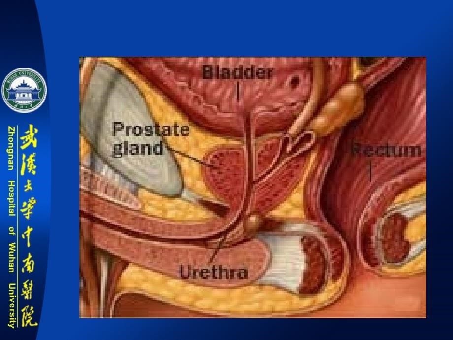 前列腺炎诊疗进展(郑新民讲稿)_第5页