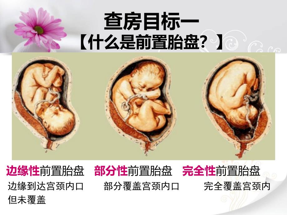 前置胎盘教学查房模板_第3页