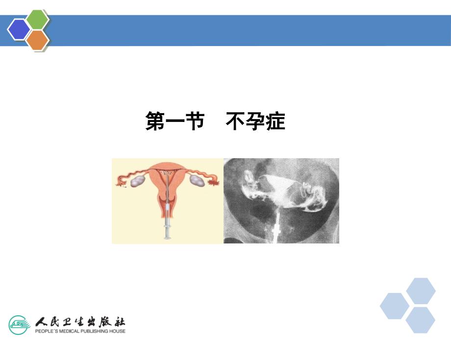 人类辅助生殖技术的并发症_第4页