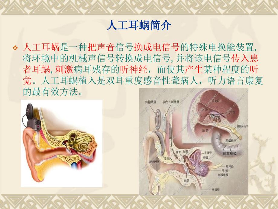 儿童人工耳蜗植入术的简介及麻醉要点_第2页
