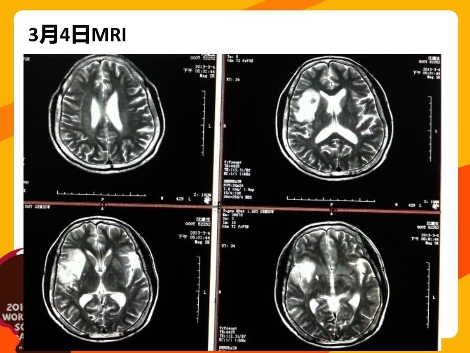 发作性抽搐病例讨论病毒性脑炎临床和影像特点_第5页