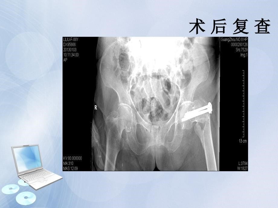 粗隆间骨折护理查房_第5页