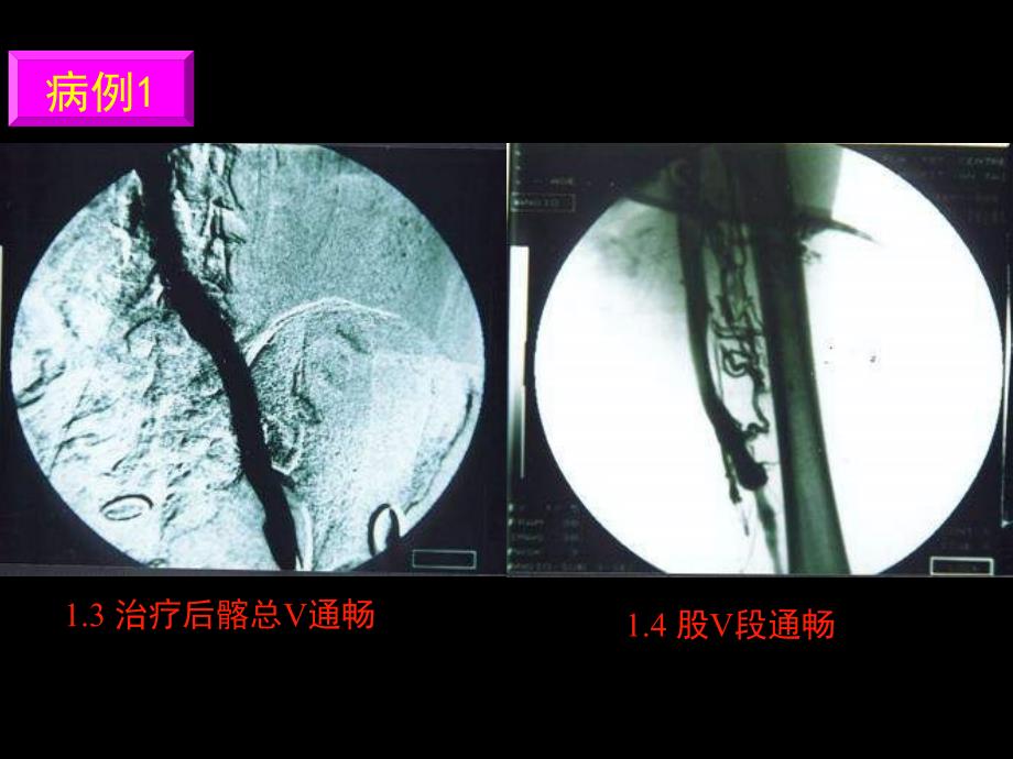 急性下肢深静脉血栓形成外科治疗病例分析解析_第4页