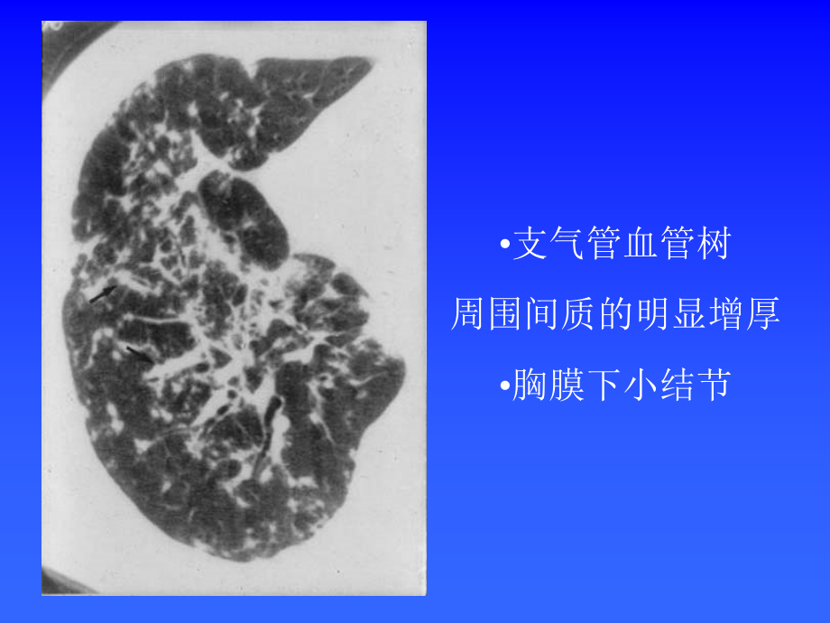 肺弥漫性病变ct_第4页