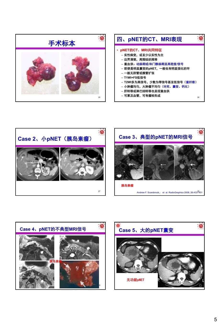 胰腺神经内分泌肿瘤的ct、mri检查与诊断_第5页
