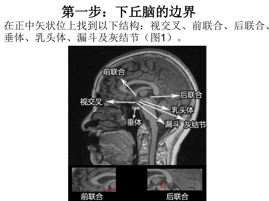 下丘脑影像解剖_第3页