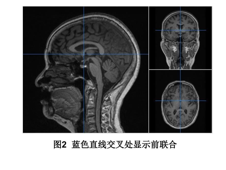 下丘脑影像解剖_第5页