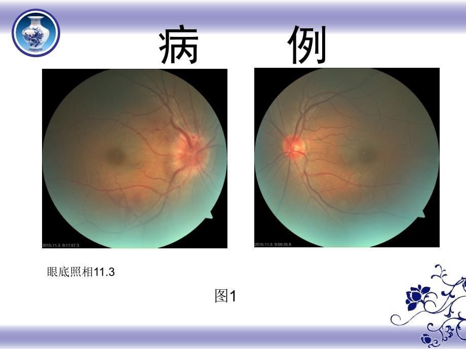 视神经炎(1)_第5页