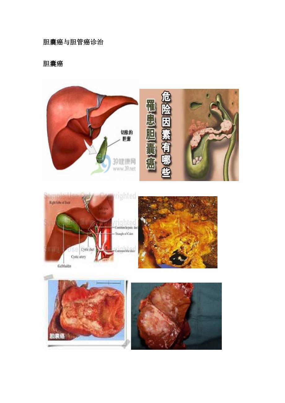 胆囊癌与胆管癌诊治_第1页