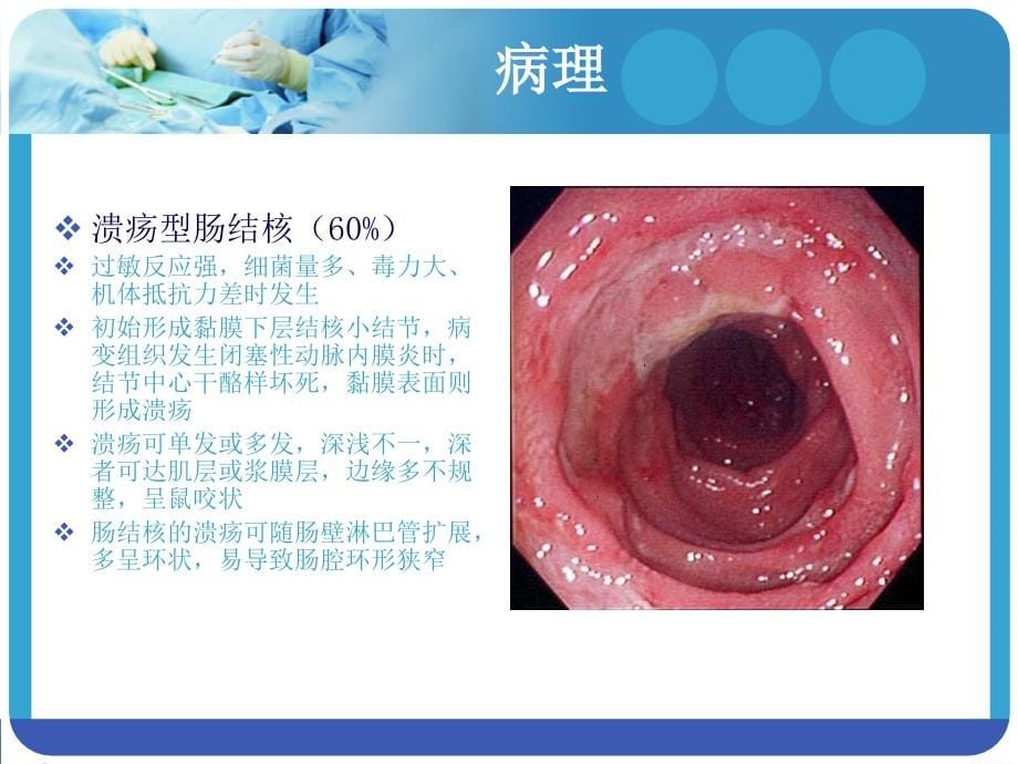 肠结核与结核性腹膜炎---副本_第5页