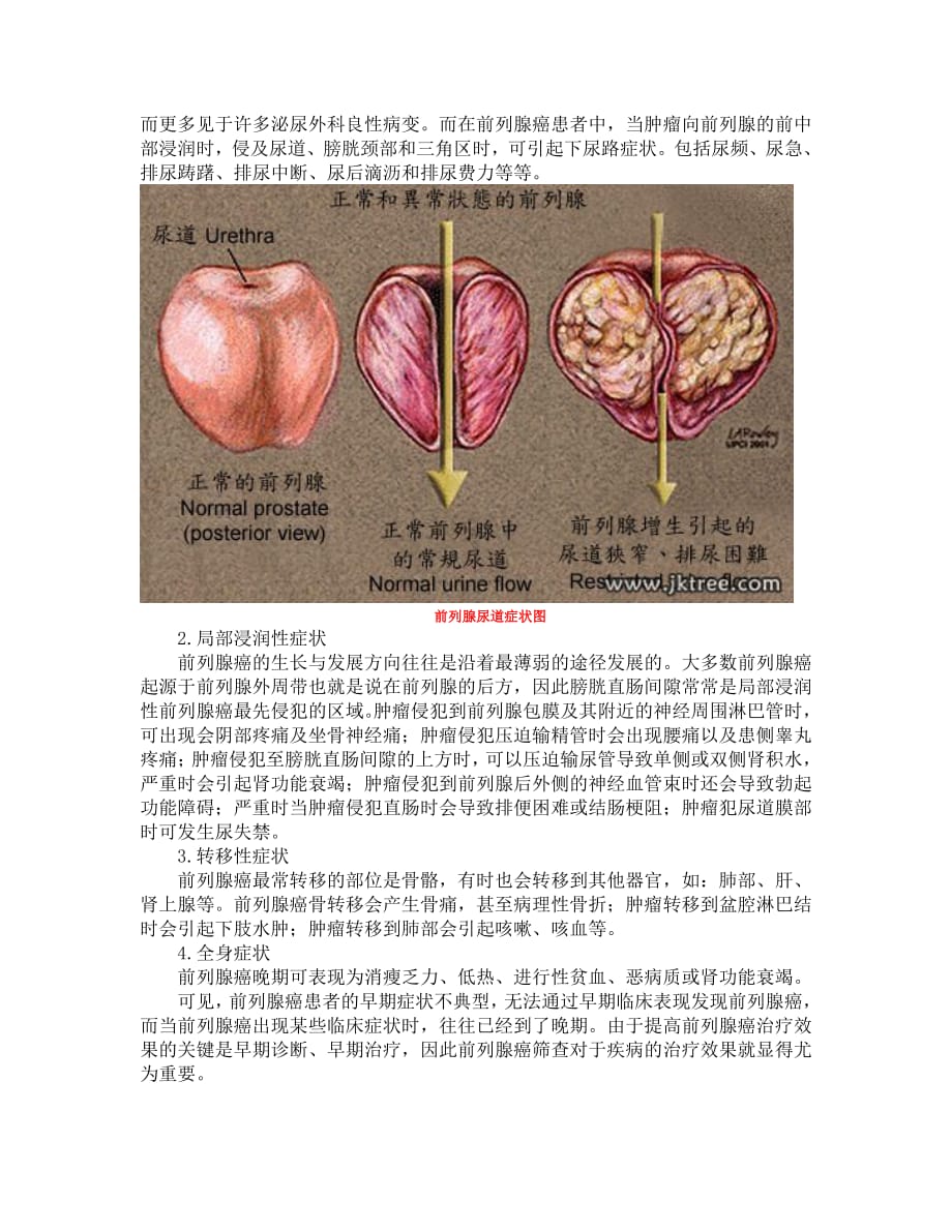 解析前列腺癌相关知识_第4页