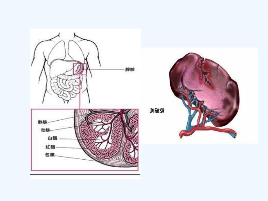 脾破裂治疗和护理_第4页