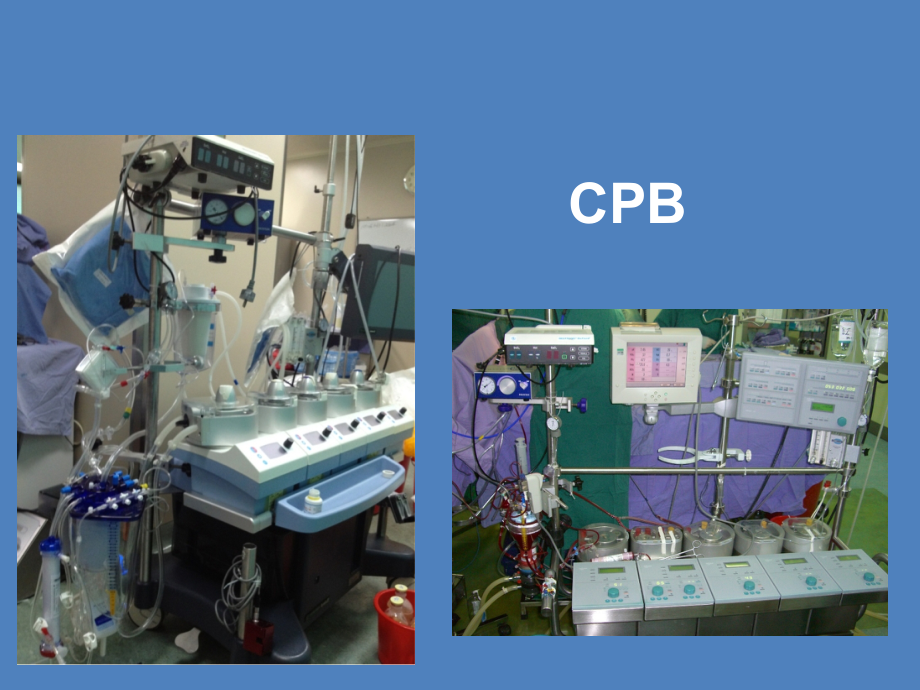 ecmo 简述讲课_第4页