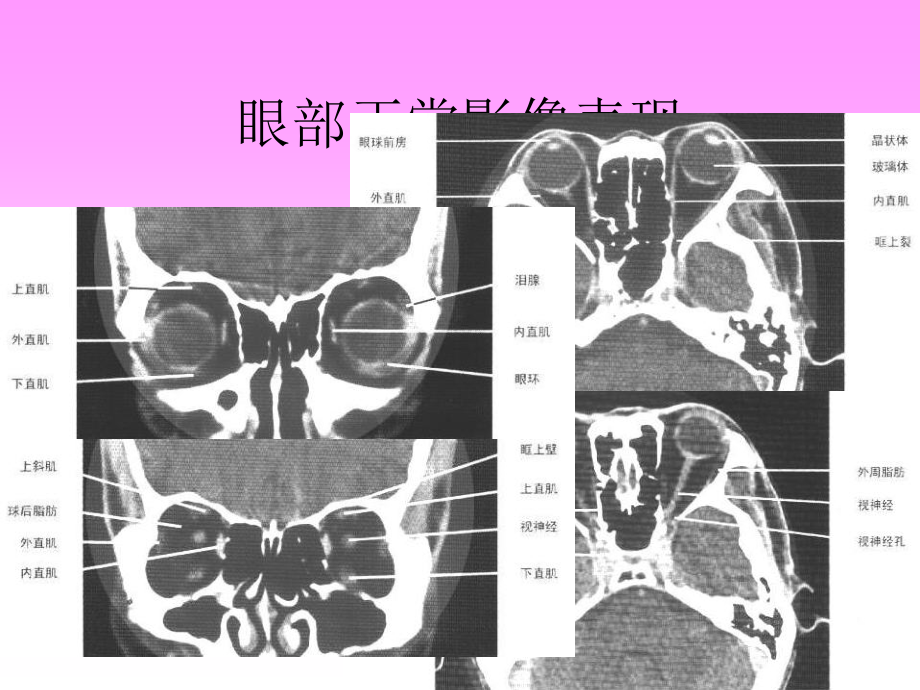 头颈部疾病ct诊断_第3页