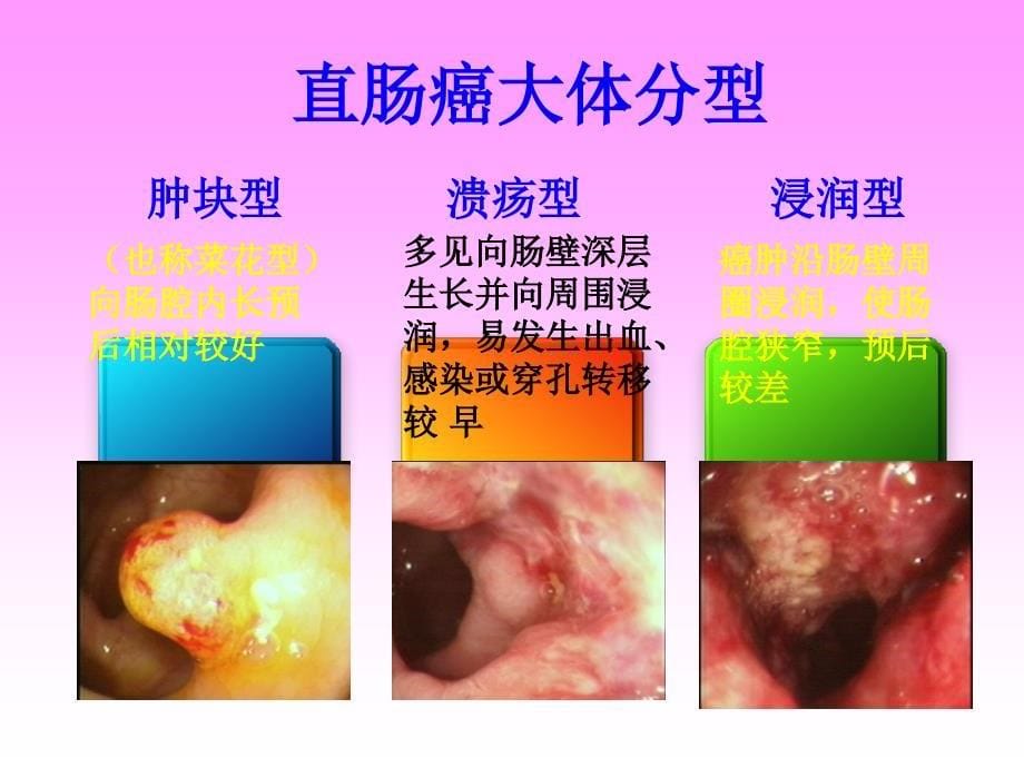 修改后直肠癌放射治疗及护理_第5页