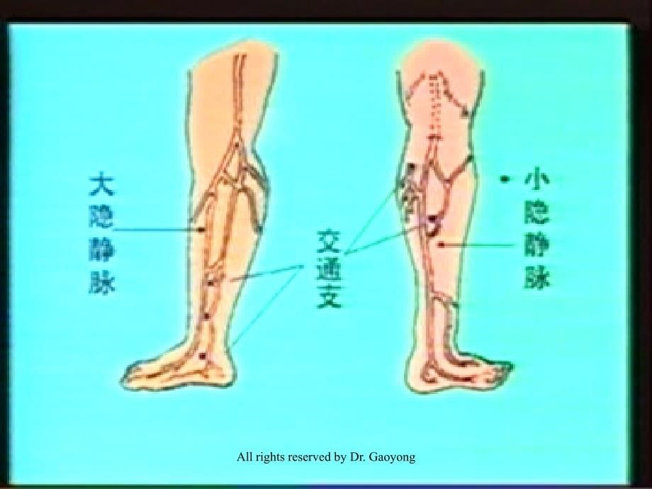 cockett综合症诊断及治疗_第5页