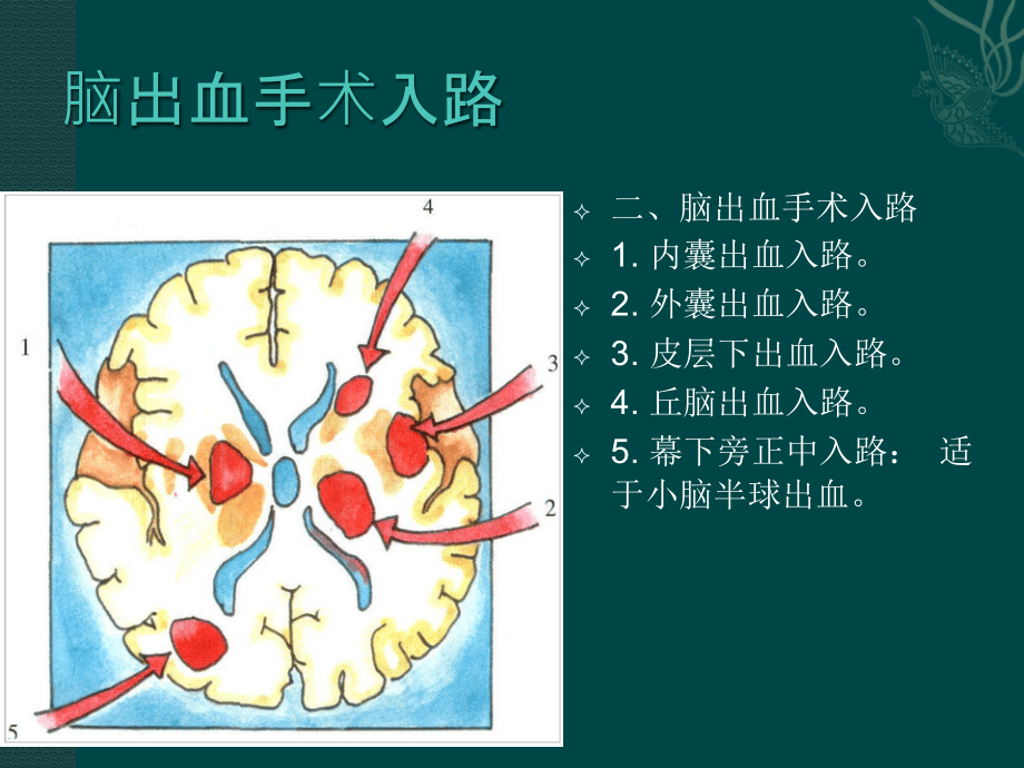 神经外科手术入路(精品)_第2页