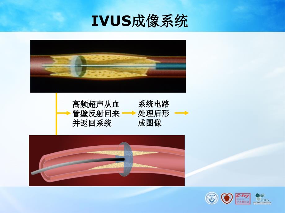 oct ivus 检测技术在冠脉介入诊治中的应用_第4页