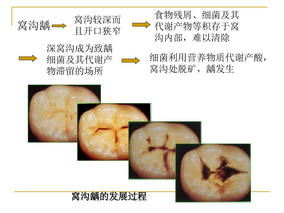 2016窝沟封闭培训 上虞区疾控中心_第4页