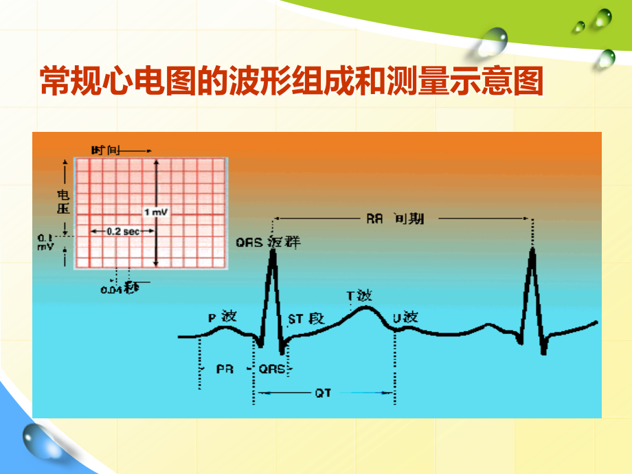 常见心脏疾病心电图表现2资料_第4页