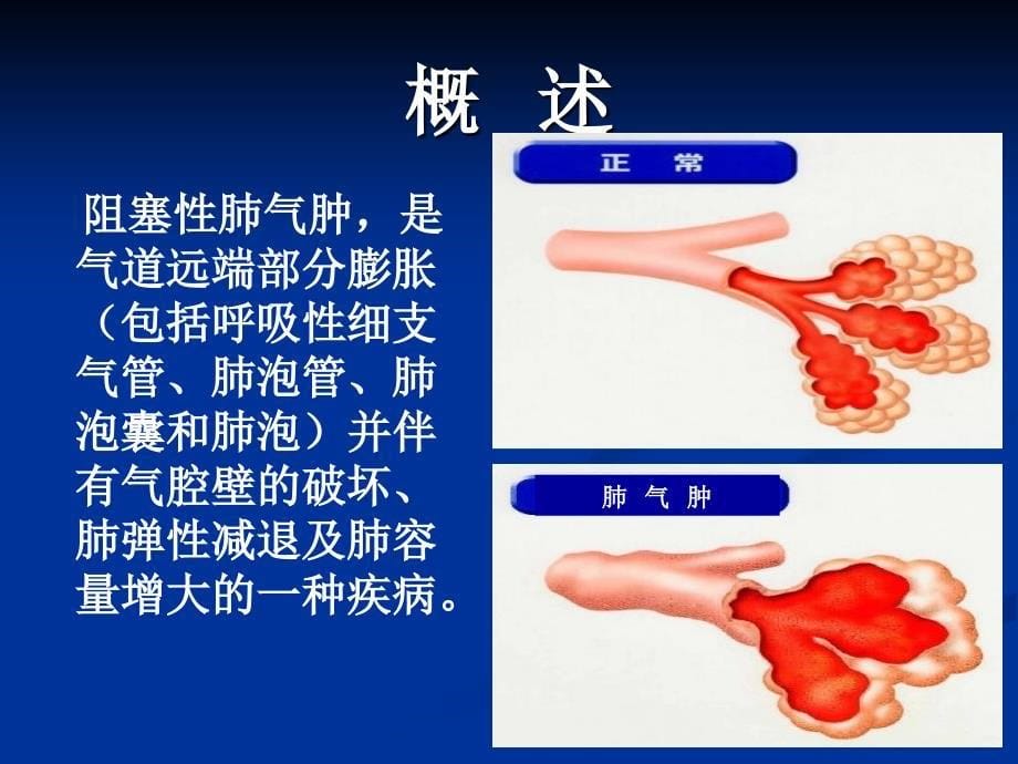 慢性阻塞性肺气肿教学资料_第5页