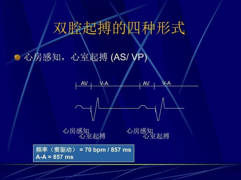 双腔起搏器技术及临床心电图表现资料_第5页