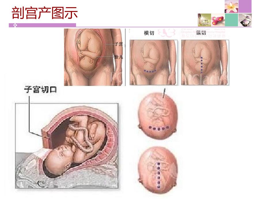 剖宫产术后护理查房1212121资料_第4页