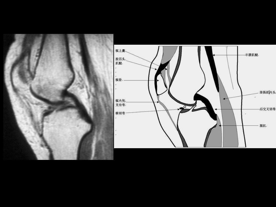 半月板和韧带核磁共振诊断资料_第5页