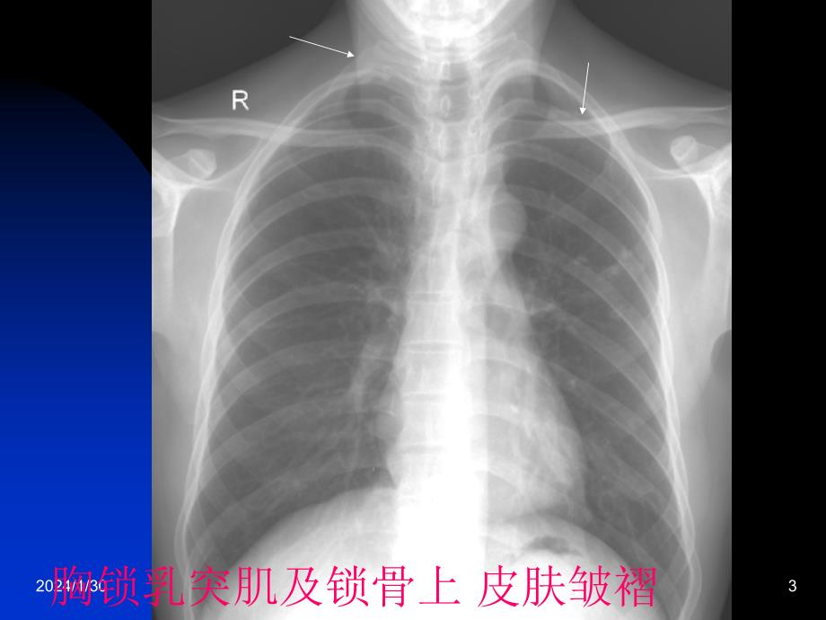 影像学呼吸系统正常影像表现_第3页