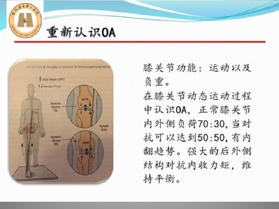 胫骨高位截骨治疗膝关节骨性关节炎资料_第4页