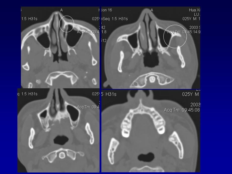 颌面部解剖及其病变的影像诊断资料_第5页