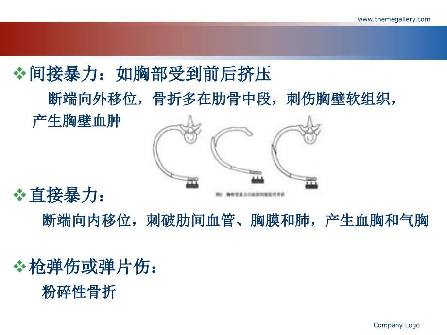 肋骨骨折的影像学表现资料_第4页