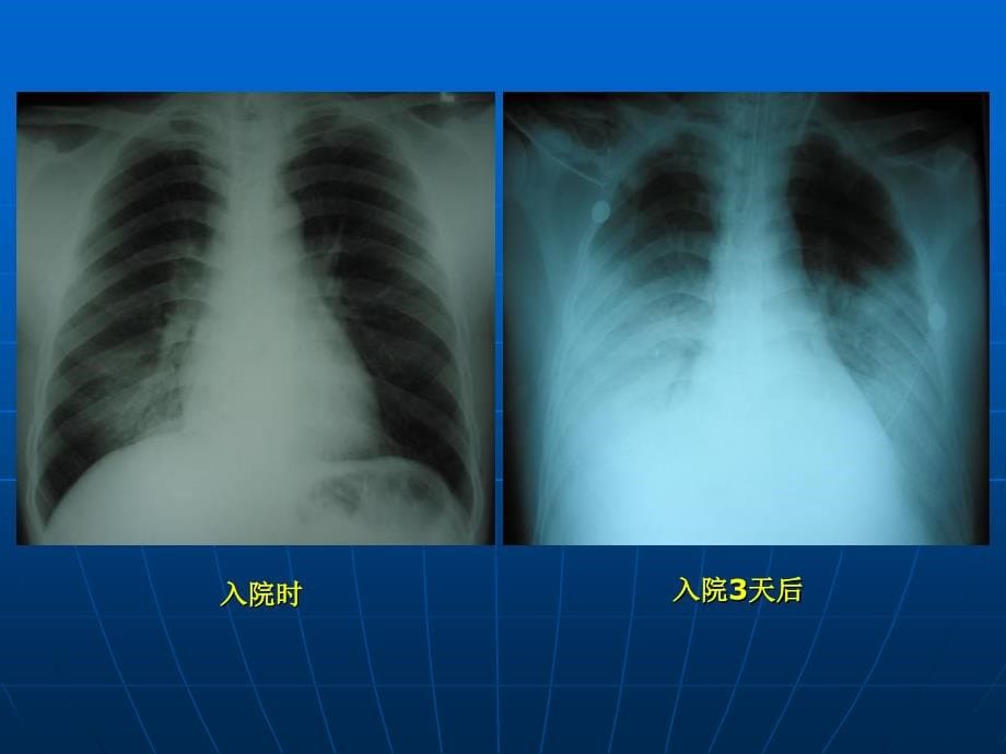 肺炎的x线表现和鉴别诊断资料_第5页