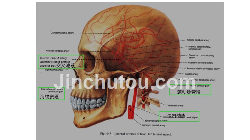 脑动脉解剖及临床脉络膜前动脉资料_第4页