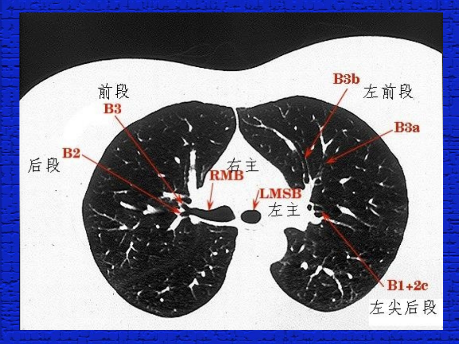 肺段支气管ct读片_第4页