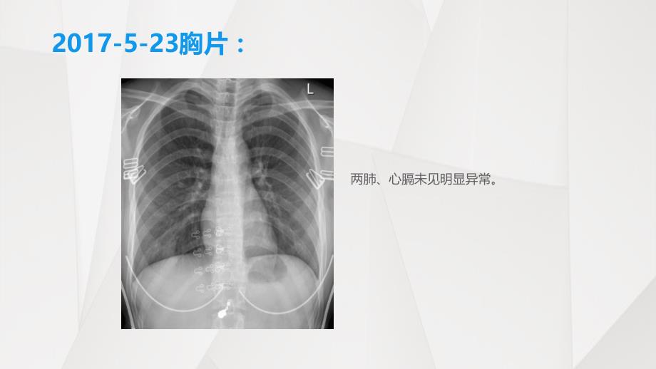 病毒性肺炎诊治与思考_第4页