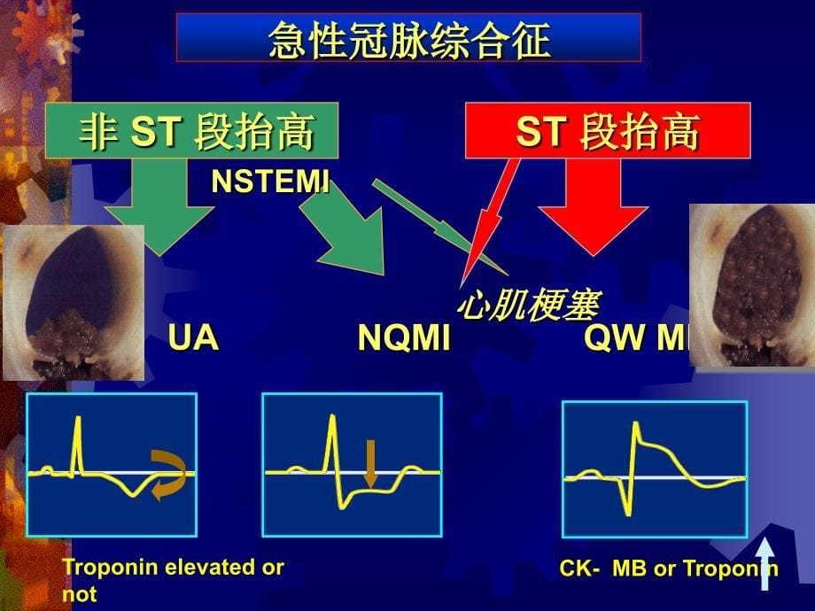 急性冠脉综合征的危险分层_第5页