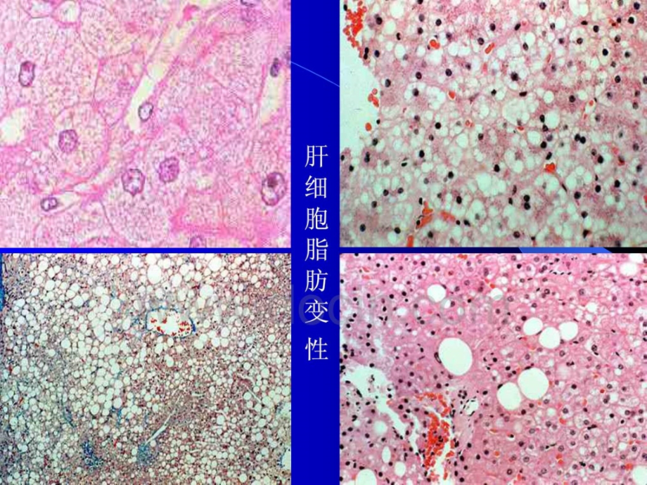 医学课件脂肪肝与动脉粥样硬化_第4页