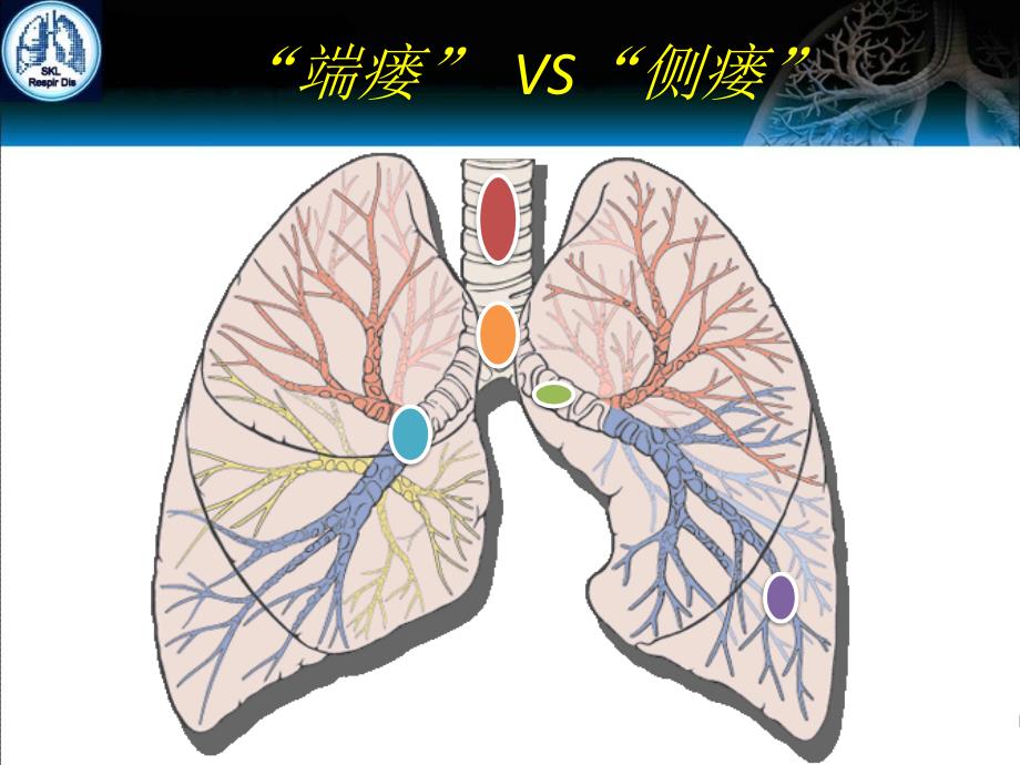 支气管瘘的治疗进展_第4页