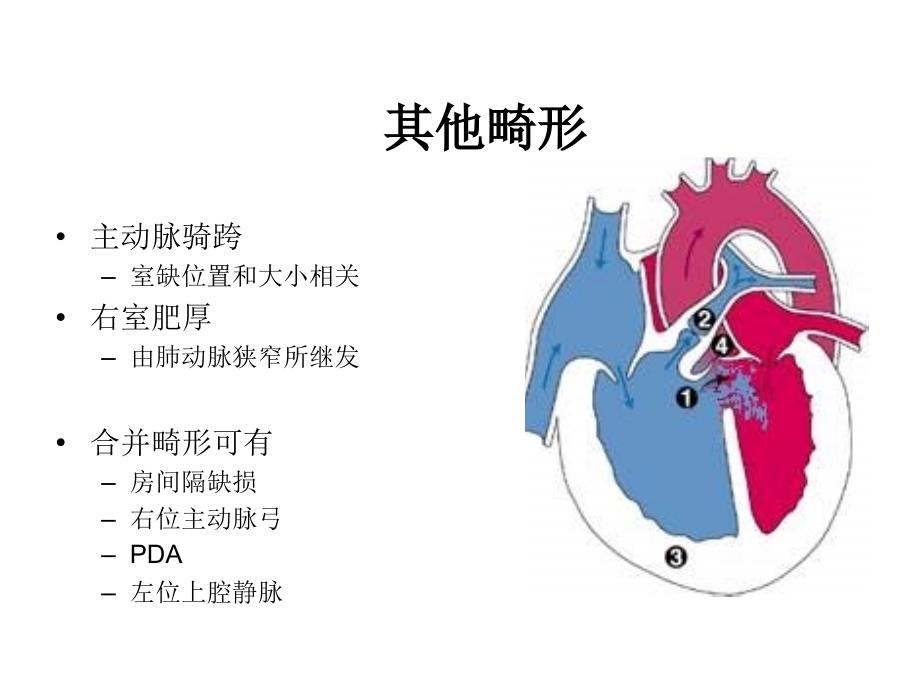 法洛四联症-心律失常_第4页