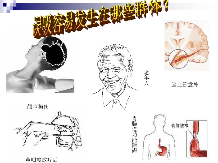 业务学习n1-n3—误吸窒息的抢救护理_第3页