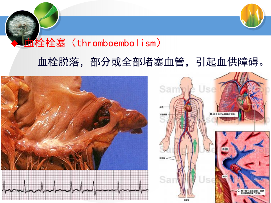 心血管疾病-溶栓抗栓治疗_第3页