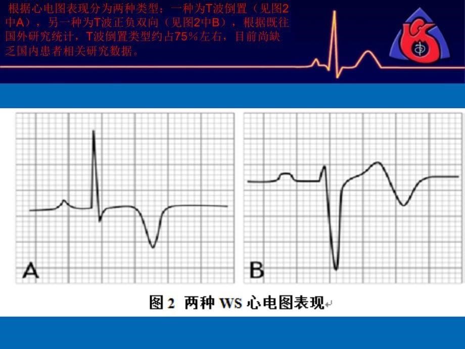 acs相关的特殊心电图表现资料_第5页