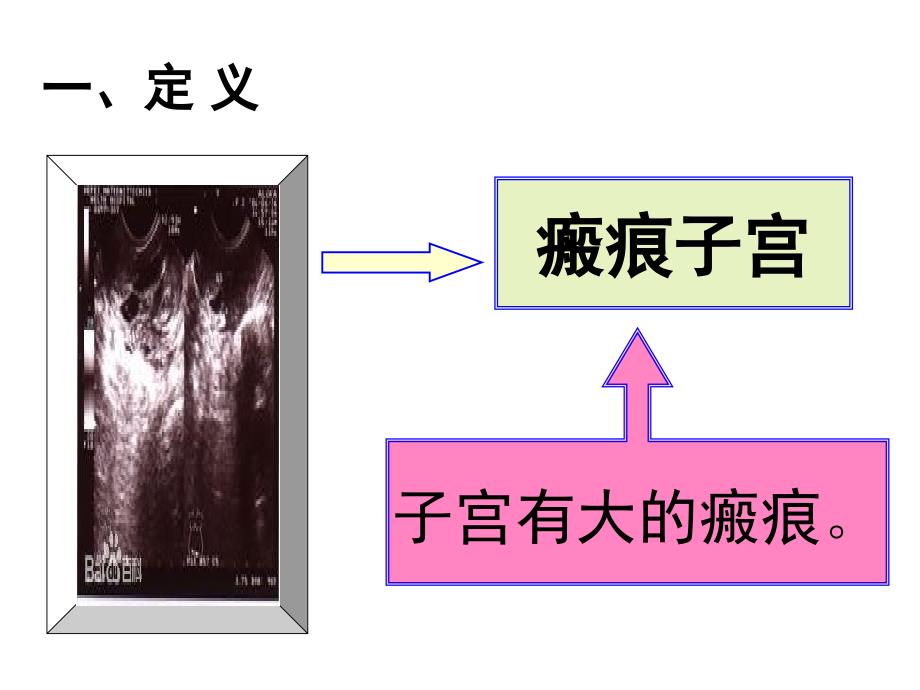 疤痕子宫再次妊娠有关问题的探讨副本_第3页