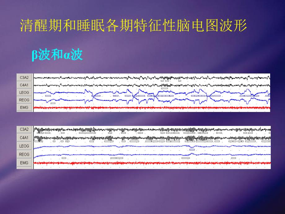 成人脑电图的判读及睡眠分期资料_第3页