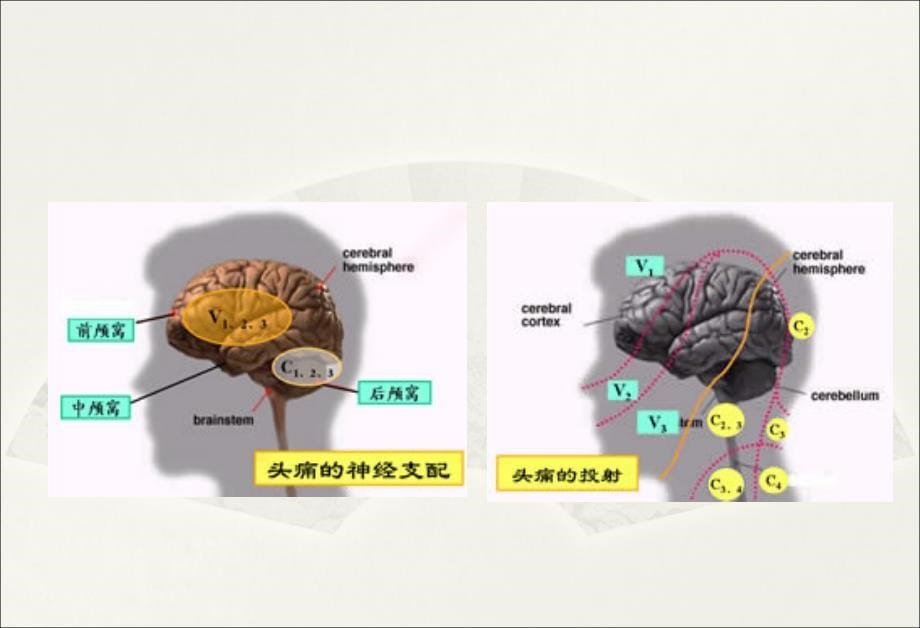 指南偏头痛_第5页