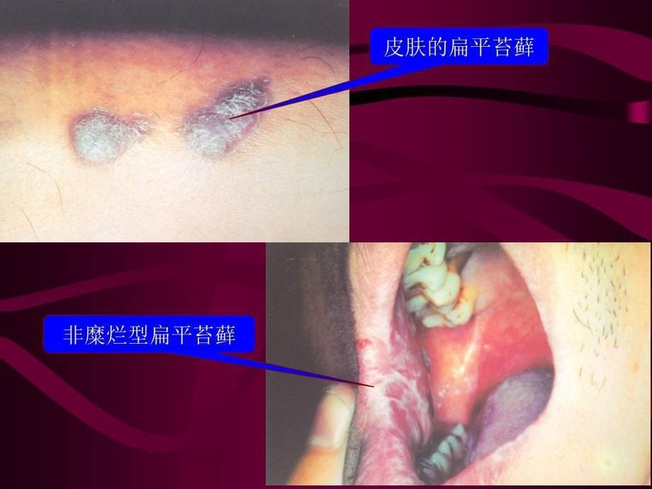 口腔粘膜斑纹类疾病医疗管理知识分析_1_第5页